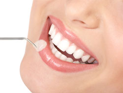 dental veneers